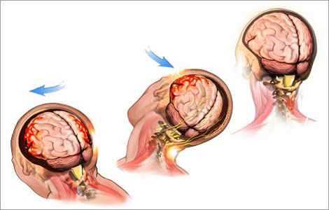 Гематома головного мозга: основные причины, симптомы и разновидности