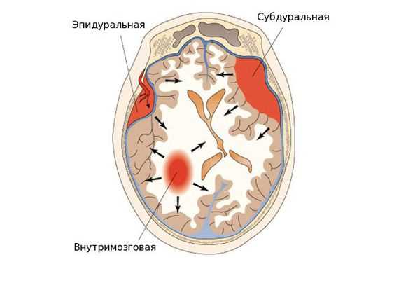 Основные симптомы гематомы головного мозга: