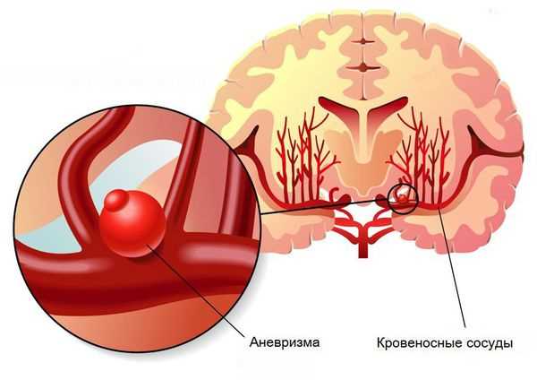 Причины гематомы головного мозга