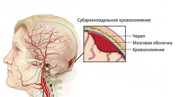 Гематома головного мозга: причины, симптомы, разновидности и лечение