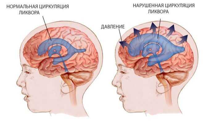Как проводится операция по шунтированию гидроцефалии головного мозга?