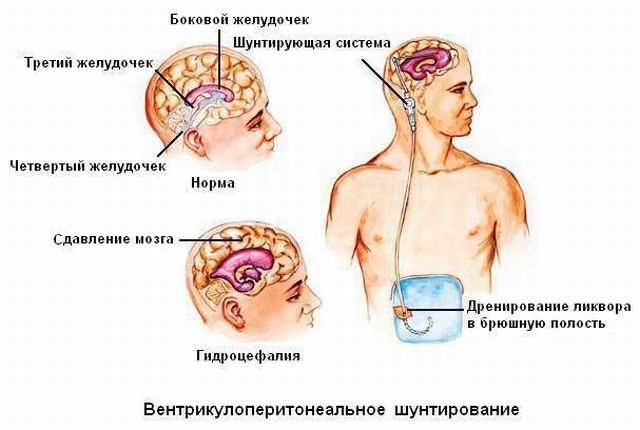Гидроцефалия головного мозга и шунтирование