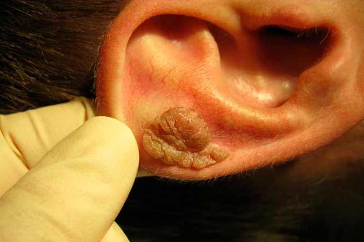 Осложнения онемения уха