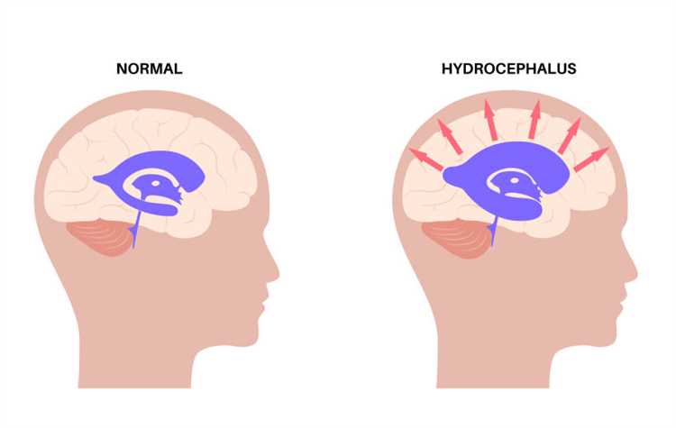 Внутренняя гидроцефалия: особенности, симптомы и лечение