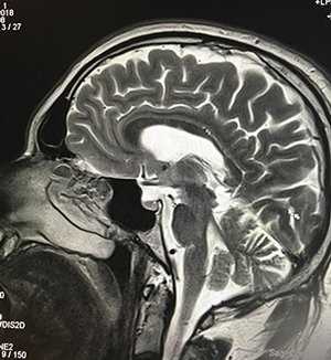 Влияние МРТ головного мозга на организм: особенности и преимущества