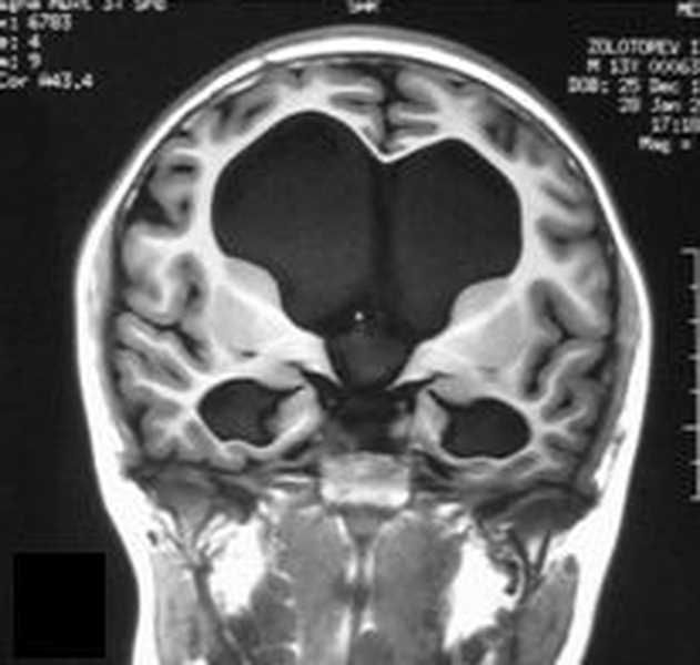 Заместительная наружная гидроцефалия головного мозга: что это такое и как лечить